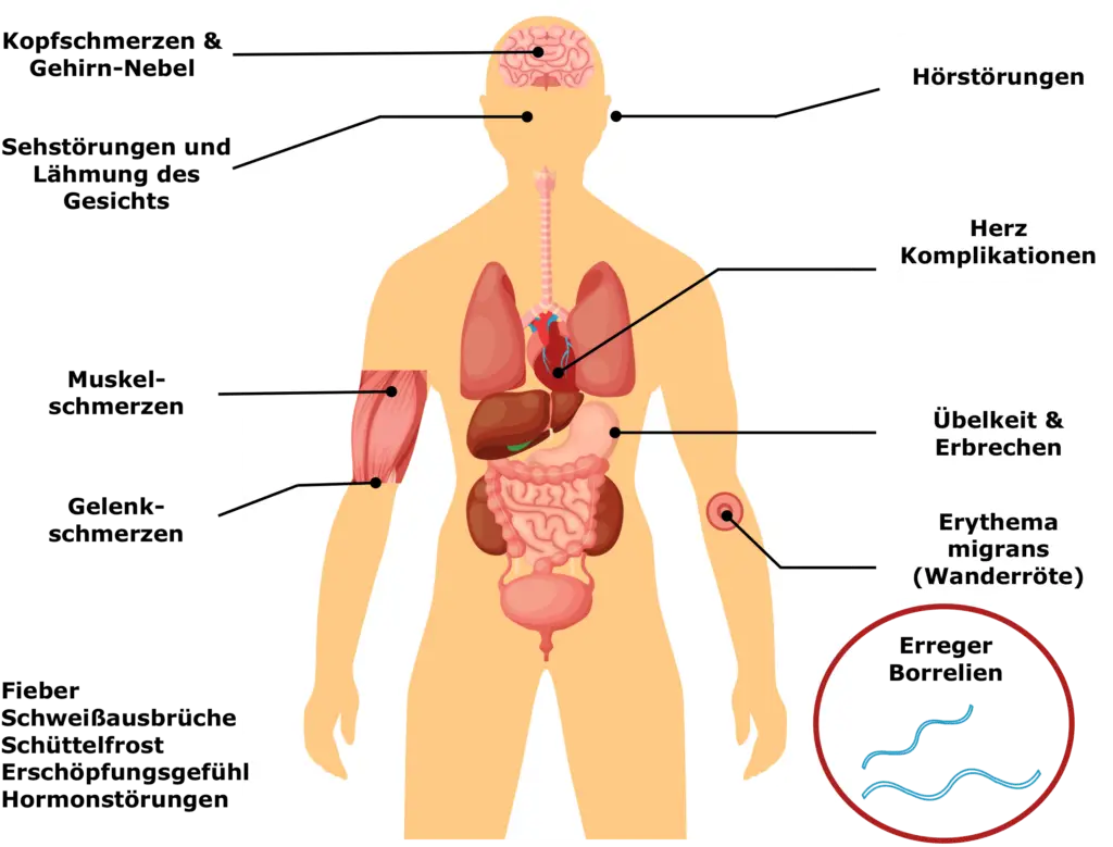 Borreliose Symptome V2